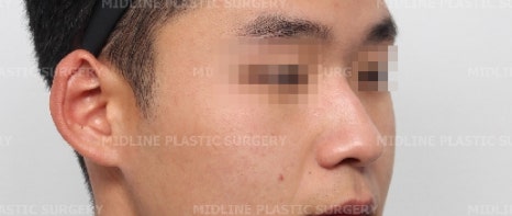 휜 코, 매부리 교정과 기능코-비중격만곡증까지 바로잡기 관련 이미지 28