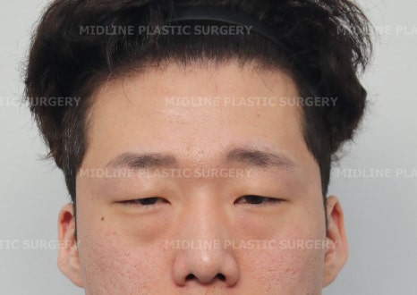 <3편> 큰 눈 만들기 프로젝트. 이마거상으로 커진 눈!! 쌍꺼풀 수술로 더 크게 만들기. 관련 이미지 7