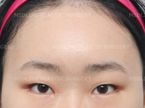 <3편> 큰 눈 만들기 프로젝트. 이마거상으로 커진 눈!! 쌍꺼풀 수술로 더 크게 만들기. 관련 이미지 6