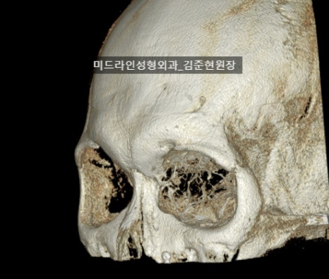 눈썹뼈 절삭에 관하여 (안와상융기) 관련 이미지 7