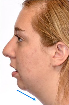 On the Effects of Advancement Genioplasty, Explained by a Board-Certified Plastic Surgeon. (feat. Rhinoplasty, Double Chin, Jawline Liposuction) image 2