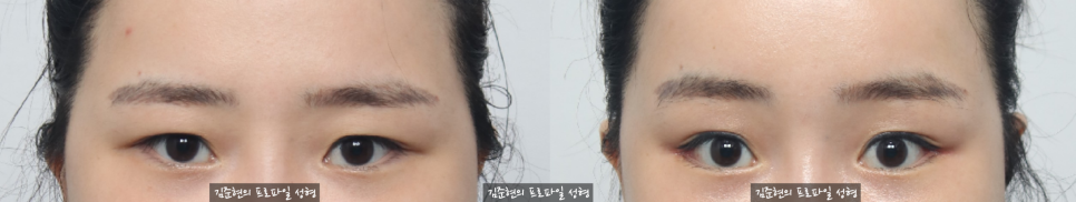 쌍꺼풀이 있는데 라인을 높이고  싶어요. 눈재수술을 하지 않고 라인 높이는 방법에 관하여 성형외과 전문의가 설명드립니다. (Feat. 내시경 이마거상, 뒤트임) 관련 이미지 2