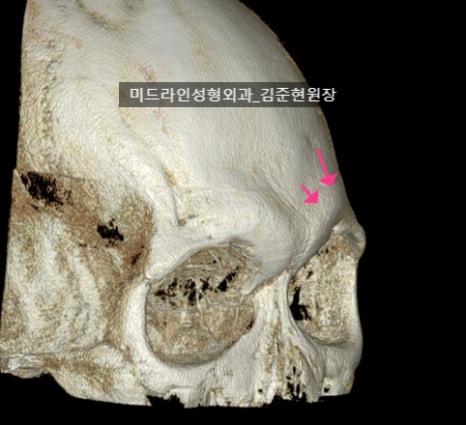 눈썹뼈 절삭에 관하여 (안와상융기) 관련 이미지 6