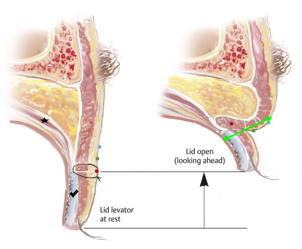 <2편> 쌍꺼풀 수술 없이 눈을 크게 만드는 방법을 성형외과 전문의가 직접 설명드립니다. 관련 이미지 6