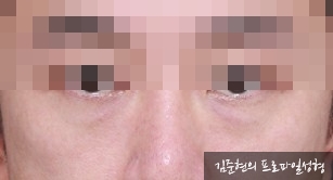 성형외과 전문의가 눈밑수술 케이스의 진단방법 및 나이들면 하는 수술이다라는 오해에 대해 설명해드립니다. 관련 이미지 9