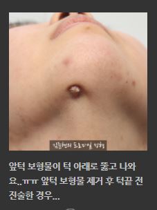 필러&middot;보형물 부작용, 골흡수 됐을 때 해결 방법은? 관련 이미지 8