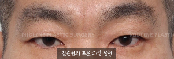쌍꺼풀을 하려는데 이마주름이 심각해요....어떡하죠? 상남자의 자연스런 쌍꺼풀 만들기(Feat. 내시경 이마거상) 관련 이미지 1