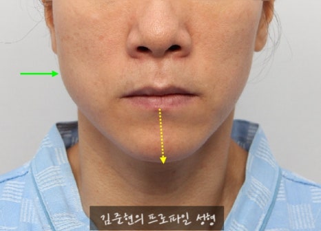 수술없이 간단하게 안면비대칭, 턱끝 비대칭(미드라인 맞추기) 해결하기!! 관련 이미지 4