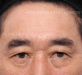 Endoscopic forehead lift that removes wrinkles and creates natural forehead volume! image 2