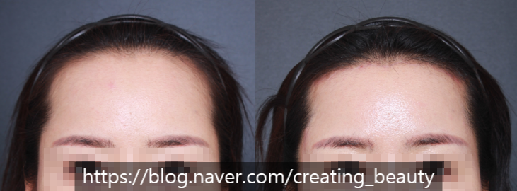 이마축소(forehead reduction)에 관하여 성형외과 전문의가 알려드립니다. 관련 이미지 9