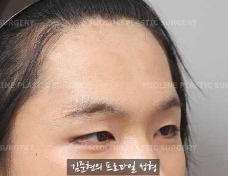 눈썹뼈절삭, 어떨 때 어떻게 하는 수술일까요? 꼭 이마거상과 함께 해야만 하는 수술인가요? 미드라인성형외과에서 하는 눈썹뼈절삭 수술을 설명드립니다. (3D CT 있음) 관련 이미지 13