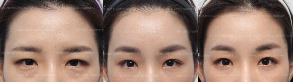 이마거상이 필요한 전형적인 케이스를 소개합니다! 더 일찍 할 껄ㅠㅠ하지 마시고 지금이 제일 빠를 때입니다. (Feat. 눈밑지방재배치와 눈밑지방이식) 관련 이미지 5