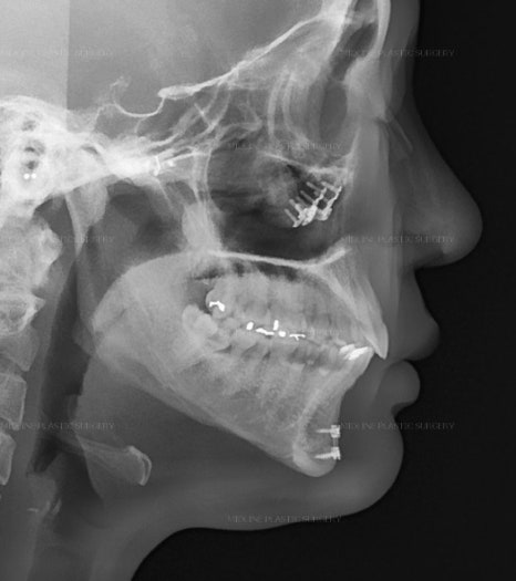 Fixing Sagging After Facial Contouring Surgery with a Face Lift!! (Feat. Plate Removal, Plate & Screw Removal) image 6