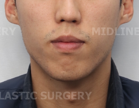 A Plastic Surgeon Explains the Changes in the Front and Side Views After Reduction Genioplasty and Advancement Genioplasty. (Feat. Rhinoplasty) image 5