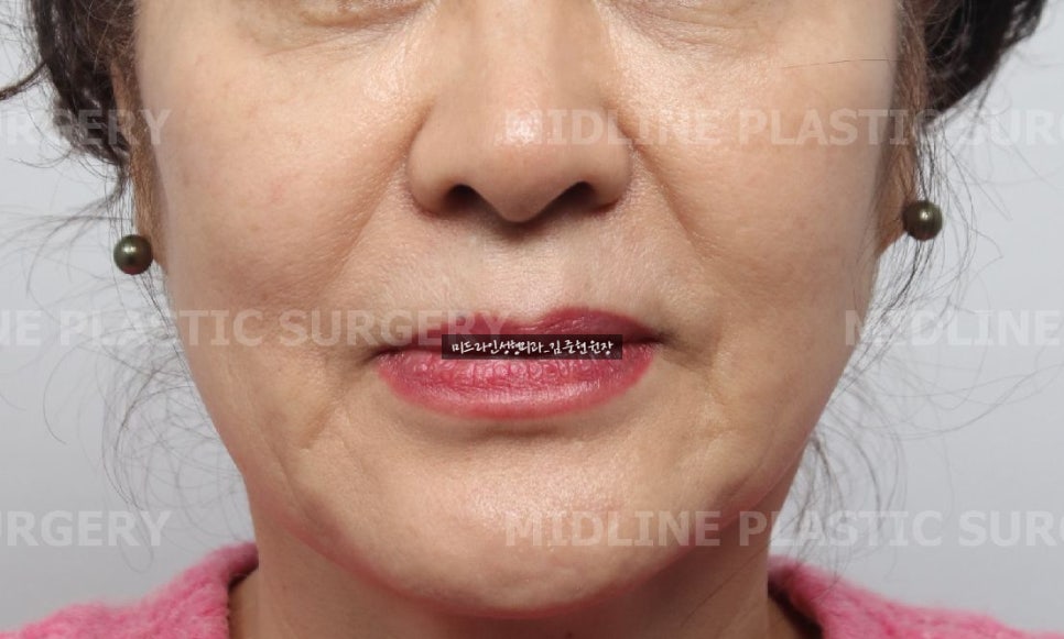 About Face Lifts That Are Effective for Improving Mouth Corners, Neck Wrinkles, and Cheek Sagging image 1