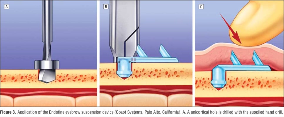 Forehead Lift! Endotine vs Absorbable Thread — Explaining the Differences in Results and Side Effects image 5