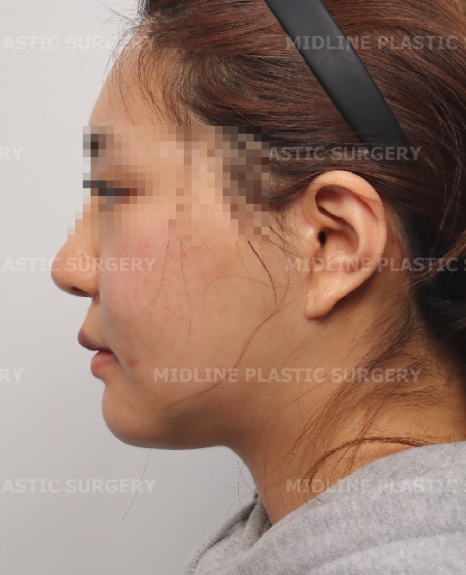 Fixing Sagging After Facial Contouring Surgery with a Face Lift!! (Feat. Plate Removal, Plate & Screw Removal) image 12