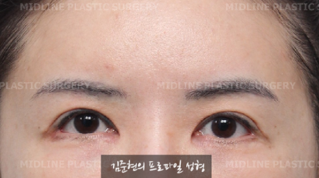 The outer corners of my eyes are open and my eyes stingㅠㅠI had lateral canthoplasty revision and eye corner restoration.(feat. Endoscopic forehead lift) image 7
