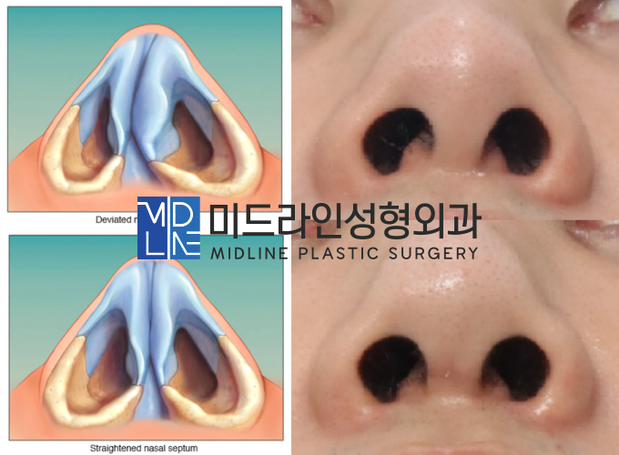 The Plastic Surgery Specialist Explains Septoplasty, One of the Methods for Functional Nose Surgery for Rhinitis. (feat. Swing-door Technique) image 10