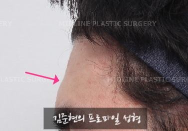 Let’s Learn About the Effects of Brow Bone Reduction Surgery. (Brow Bone? Eye Hole Bone? Here’s a Terminology Guide.) image 5