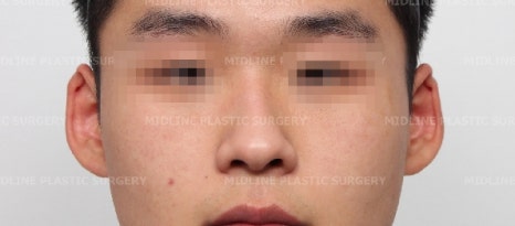 휜 코, 매부리 교정과 기능코-비중격만곡증까지 바로잡기 관련 이미지 2