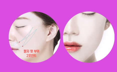 인디언 주름 고민 해결! 중안면부 리프팅에 대하여 설명드립니다. 관련 이미지 23