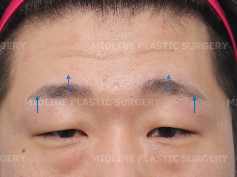 <1편> 쌍꺼풀 수술 없이 눈을 크게 만드는 방법을 성형외과 전문의가 직접 설명드립니다. 관련 이미지 12