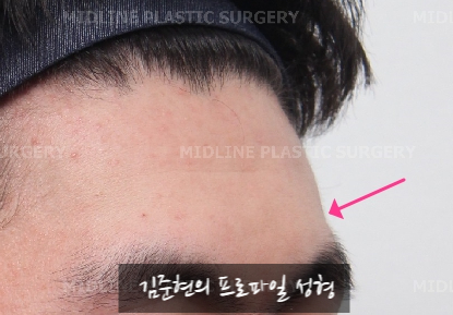Let’s Learn About the Effects of Brow Bone Reduction Surgery. (Brow Bone? Eye Hole Bone? Here’s a Terminology Guide.) image 21