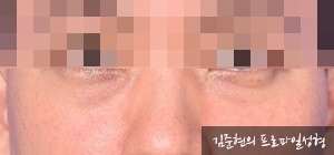 성형외과 전문의가 눈밑수술 케이스의 진단방법 및 나이들면 하는 수술이다라는 오해에 대해 설명해드립니다. 관련 이미지 7