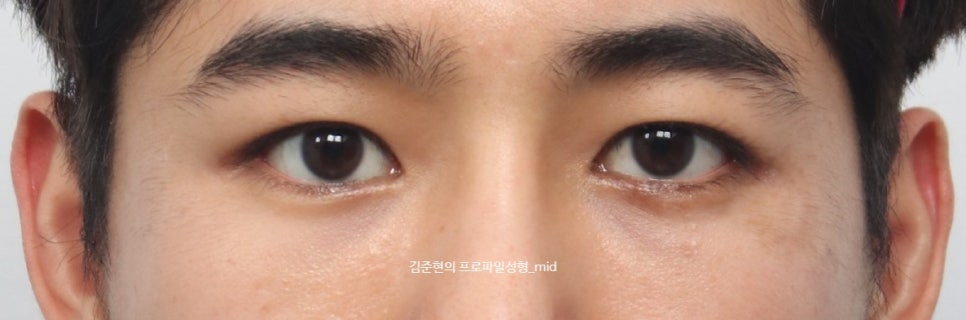 미드라인성형외과 김준현원장이 알려주는 눈밑지방재배치와 눈밑지방이식. 관련 이미지 4