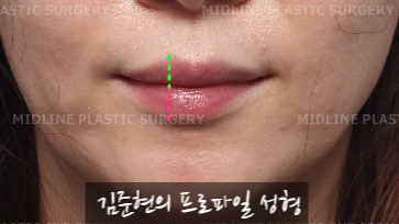 입술에 볼륨을 주는 방법은? 입술 지방이식에 관하여 관련 이미지 8