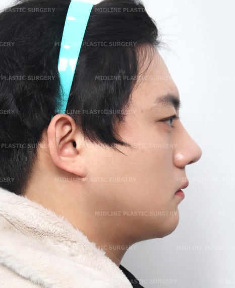 이중턱 지방흡입의 효과에 대하여 전문의가 알려드립니다. 관련 이미지 5