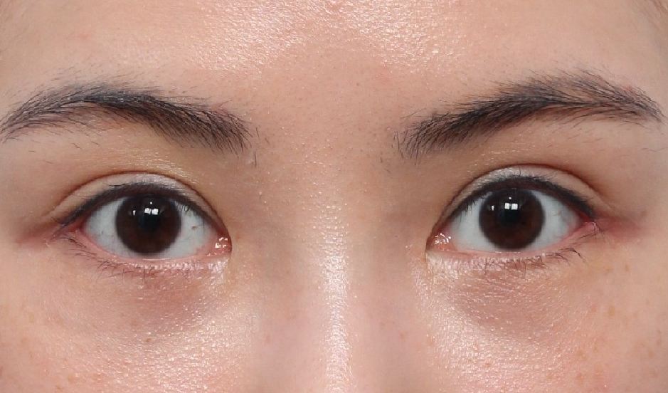What Type of Plastic Surgery Is Needed for Small, Cramped Eyes? (About Lateral, Lower, and Combined Lateral-Lower Canthoplasty) image 25