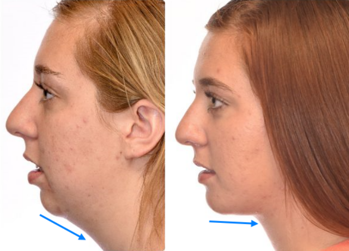 On the Effects of Advancement Genioplasty, Explained by a Board-Certified Plastic Surgeon. (feat. Rhinoplasty, Double Chin, Jawline Liposuction) image 3