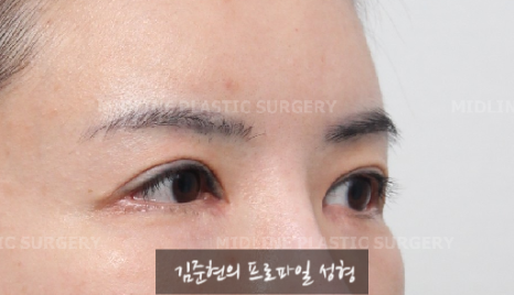 The outer corners of my eyes are open and my eyes stingㅠㅠI had lateral canthoplasty revision and eye corner restoration.(feat. Endoscopic forehead lift) image 9