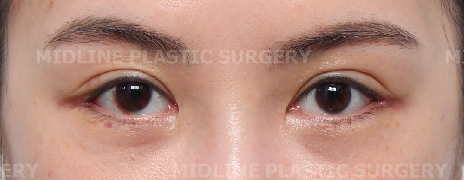 What Type of Plastic Surgery Is Needed for Small, Cramped Eyes? (About Lateral, Lower, and Combined Lateral-Lower Canthoplasty) image 24