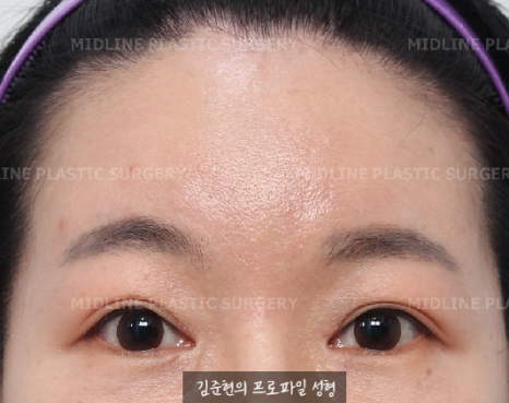 Because of the Mongolian fold, the eyes look cramped — epicanthoplasty can fix it. (Feat. Endoscopic forehead lift) image 11