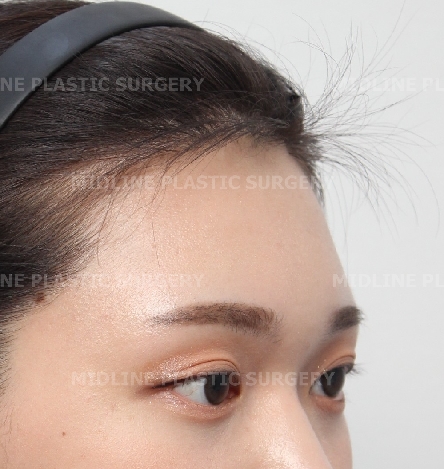 Forehead Lift for a Forehead with Prominent Brow Bones?? image 9