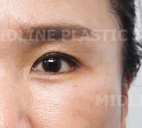 What Type of Plastic Surgery Is Needed for Small, Cramped Eyes? (About Lateral, Lower, and Combined Lateral-Lower Canthoplasty) image 20