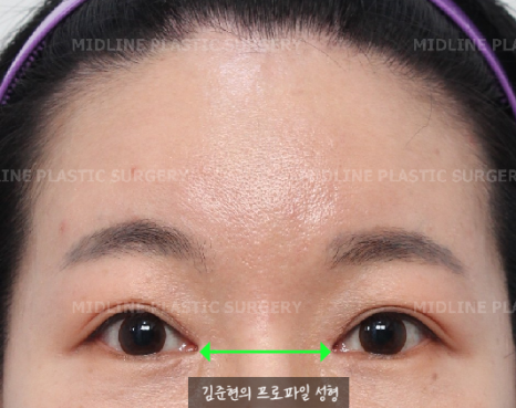 Because of the Mongolian fold, the eyes look cramped — epicanthoplasty can fix it. (Feat. Endoscopic forehead lift) image 7