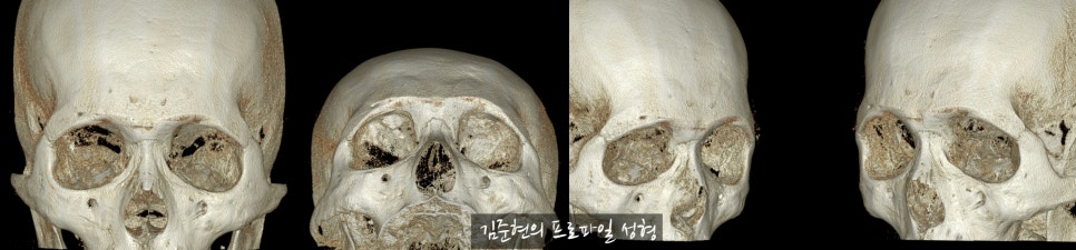 눈썹뼈절삭, 어떨 때 어떻게 하는 수술일까요? 꼭 이마거상과 함께 해야만 하는 수술인가요? 미드라인성형외과에서 하는 눈썹뼈절삭 수술을 설명드립니다. (3D CT 있음) 관련 이미지 16