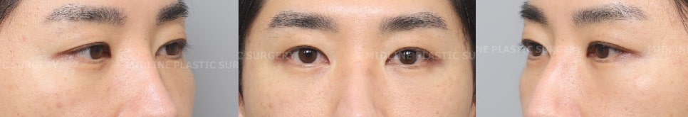 I Want to Get Rid of the Foreign Material Under My Eyes (Radiesse)ㅠ A Plastic Surgeon Explains Cases of Under-Eye Foreign Material Removal image 4
