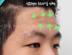 How Can Deep Forehead Wrinkles Be Resolved? (Feat. Forehead Lift + Filler) image 8