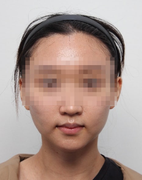 무턱 교정하면서 턱끝 비대칭(안면비대칭)까지 바로잡기! 관련 이미지 11
