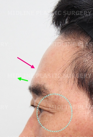 Endoscopic forehead lift that removes wrinkles and creates natural forehead volume! image 7