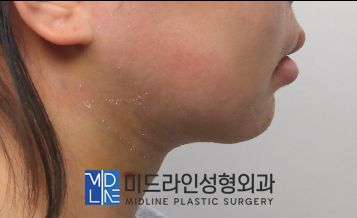 A Plastic Surgery Specialist Explains Why Chin Liposuction Is Sometimes Essential Because Jaw Reduction Surgery Alone Has Limited Effect image 13