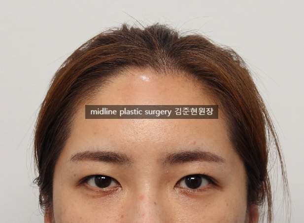Forehead lift for people in their 20s and 30s: correcting eyelid sagging and even eye asymmetry! image 2