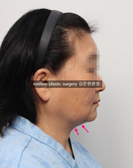 안면거상 흉터를 보여주는 곳은 없어서 미드라인성형외과가 보여드립니다. (feat. 심부볼리프팅) 관련 이미지 12
