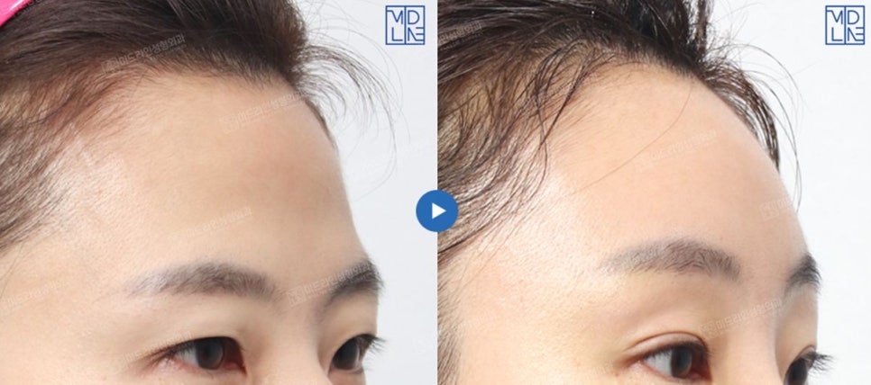 Endoscopic forehead lift that removes wrinkles and creates natural forehead volume! image 12