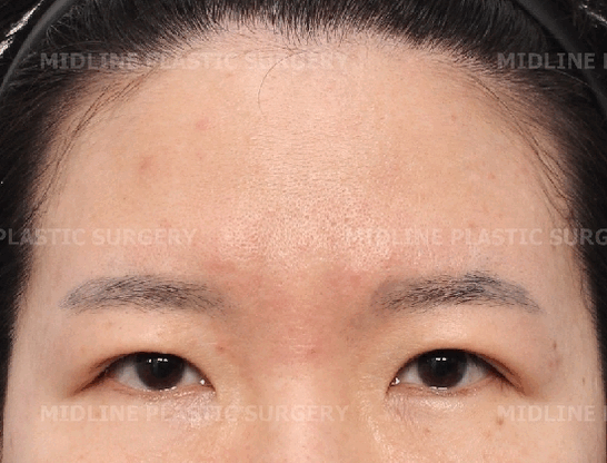 Because of the Mongolian fold, the eyes look cramped — epicanthoplasty can fix it. (Feat. Endoscopic forehead lift) image 14